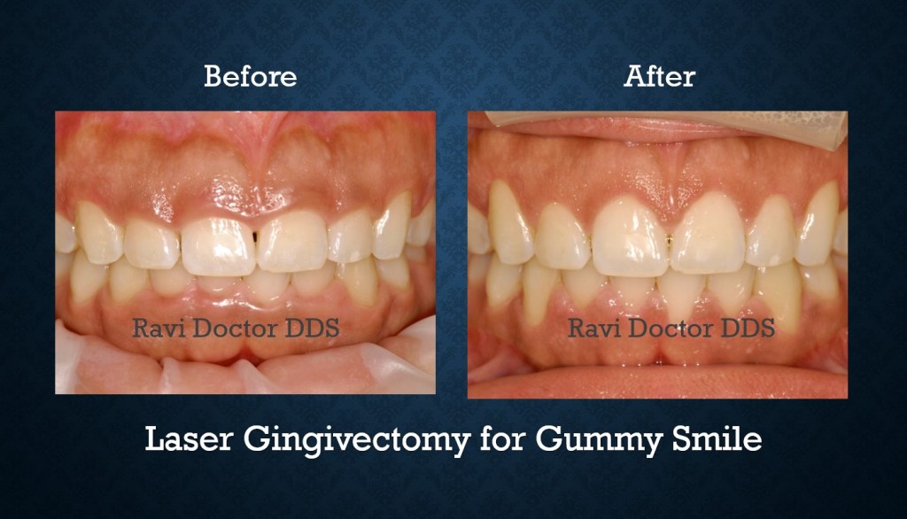 Before and after laser gingivectomy treatment creating a more balanced and symmetrical gum line