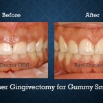 Before and after laser gingivectomy treatment creating a more balanced and symmetrical gum line