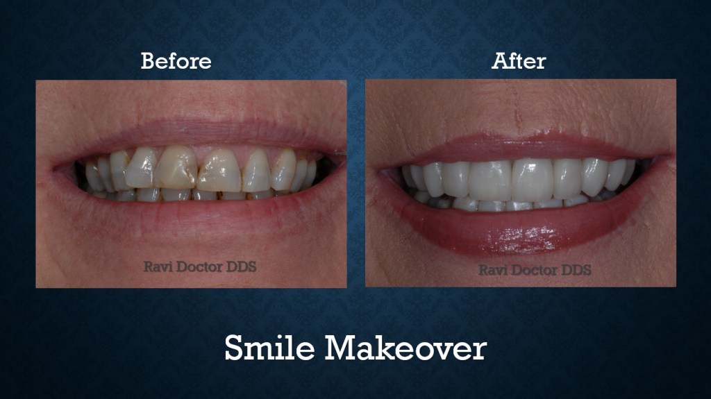 Before and after smile makeover treatment improving tooth color, shape, and overall smile aesthetics