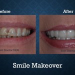 Before and after smile makeover treatment improving tooth color, shape, and overall smile aesthetics