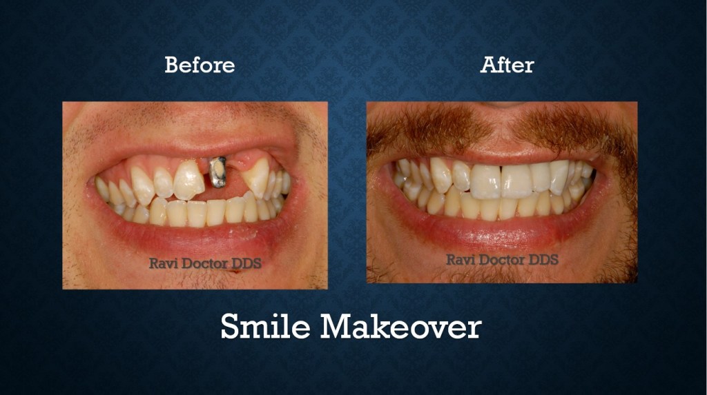 Before and after smile makeover treatment restoring damaged teeth and creating a confident smile