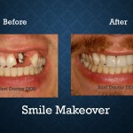 Before and after smile makeover treatment restoring damaged teeth and creating a confident smile