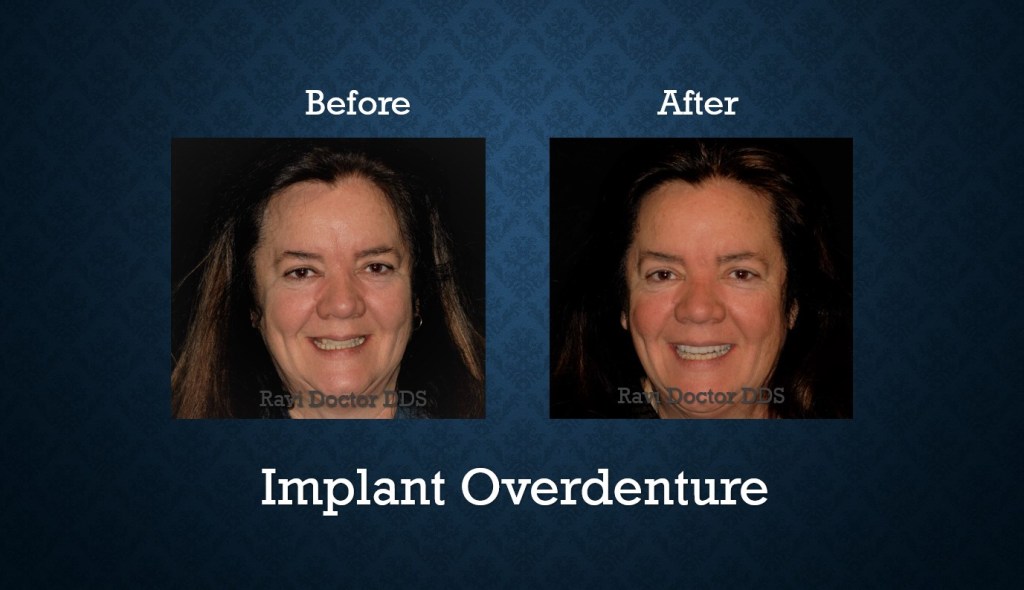 Before and after implant overdenture treatment restoring missing teeth and improving smile appearance