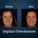 Before and after implant overdenture treatment restoring missing teeth and improving smile appearance