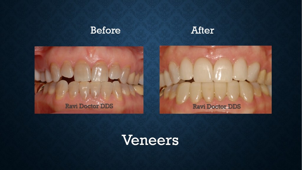 Before and after porcelain veneers treatment correcting worn and discolored teeth