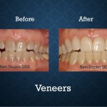 Before and after porcelain veneers treatment correcting worn and discolored teeth