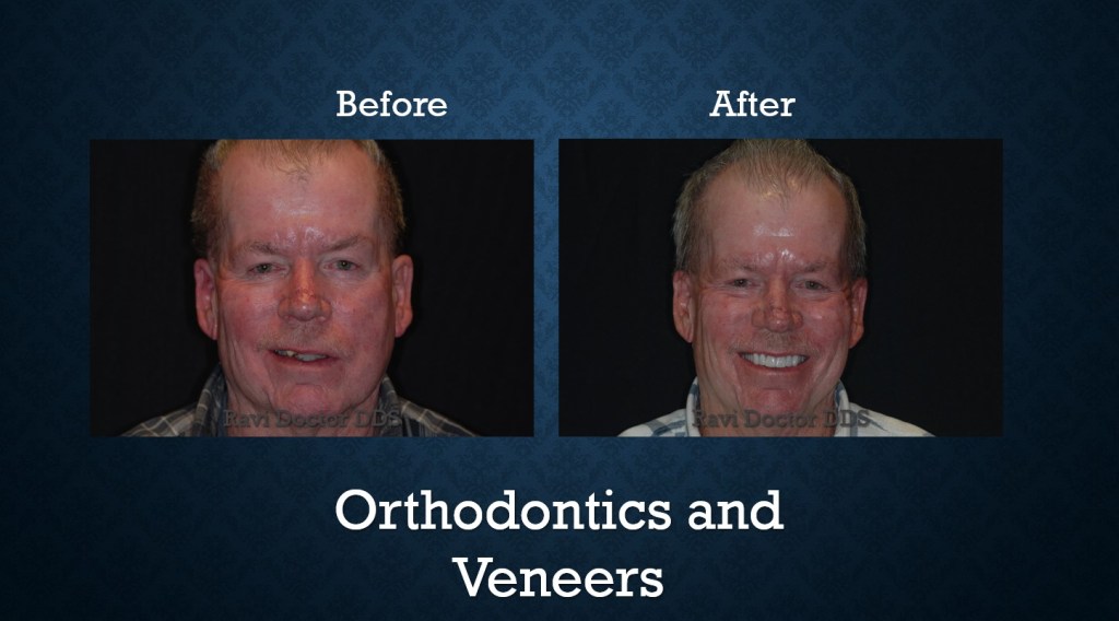 Before and after orthodontic treatment with veneers improving tooth alignment and smile aesthetics