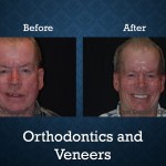 Before and after orthodontic treatment with veneers improving tooth alignment and smile aesthetics