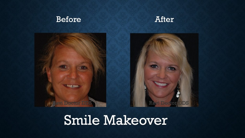 Before and after comprehensive smile makeover treatment creating a brighter, healthier smile