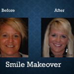 Before and after comprehensive smile makeover treatment creating a brighter, healthier smile