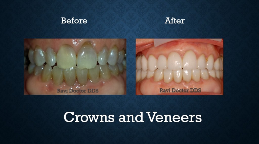 Before and after crowns and veneers treatment restoring damaged teeth and enhancing smile appearance