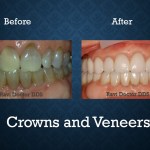 Before and after crowns and veneers treatment restoring damaged teeth and enhancing smile appearance