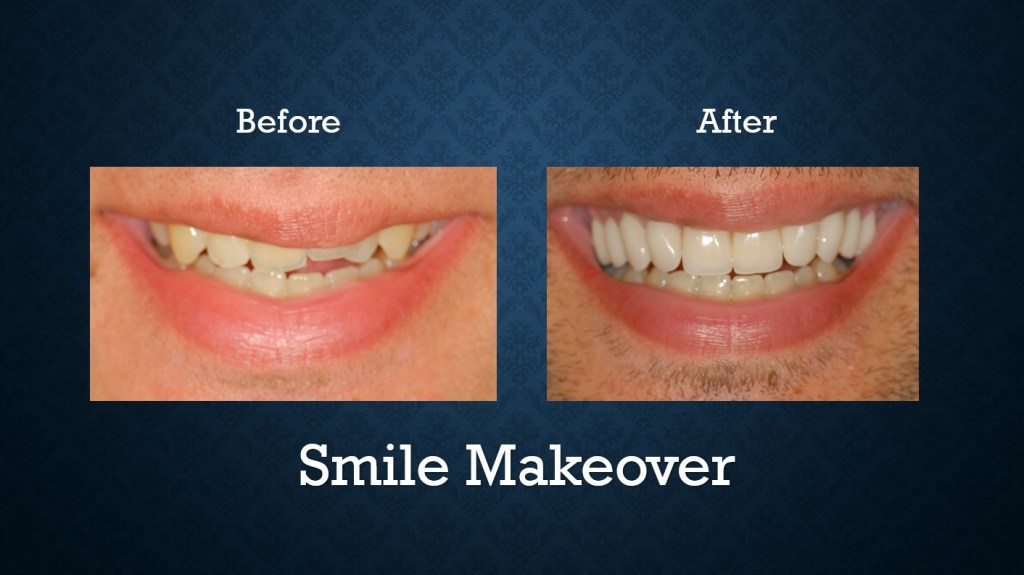 Before and after smile makeover treatment correcting damaged teeth and improving smile aesthetics