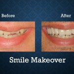 Before and after smile makeover treatment correcting damaged teeth and improving smile aesthetics