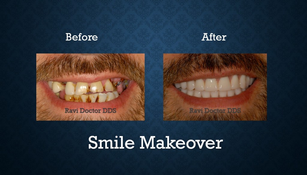 Before and after smile makeover treatment correcting damaged and missing teeth