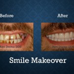 Before and after smile makeover treatment correcting damaged and missing teeth