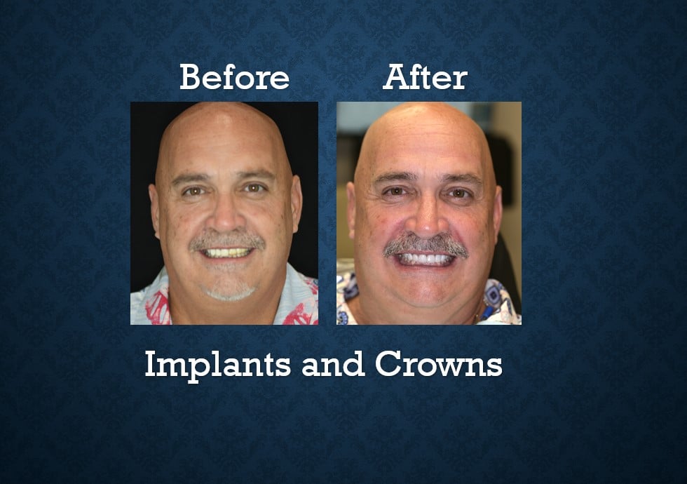 Before and after dental implants and crowns treatment restoring missing teeth and smile function