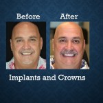 Before and after dental implants and crowns treatment restoring missing teeth and smile function