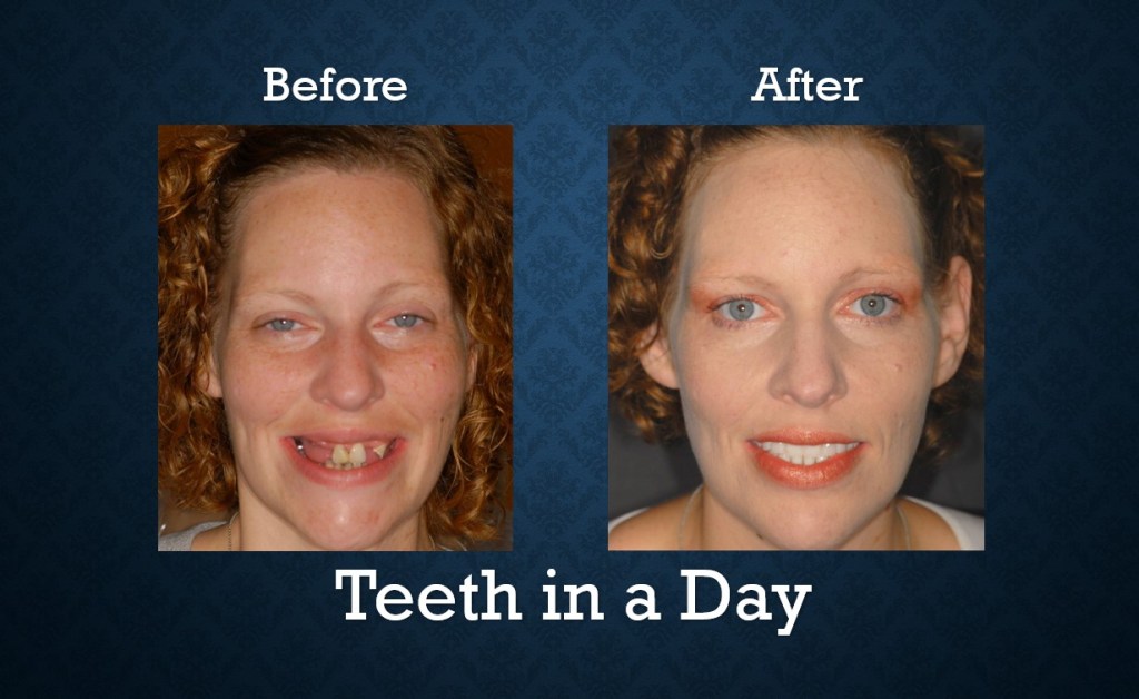 Before and after Teeth-In-A-Day treatment restoring a healthy, natural-looking smile
