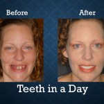 Before and after Teeth-In-A-Day treatment restoring a healthy, natural-looking smile