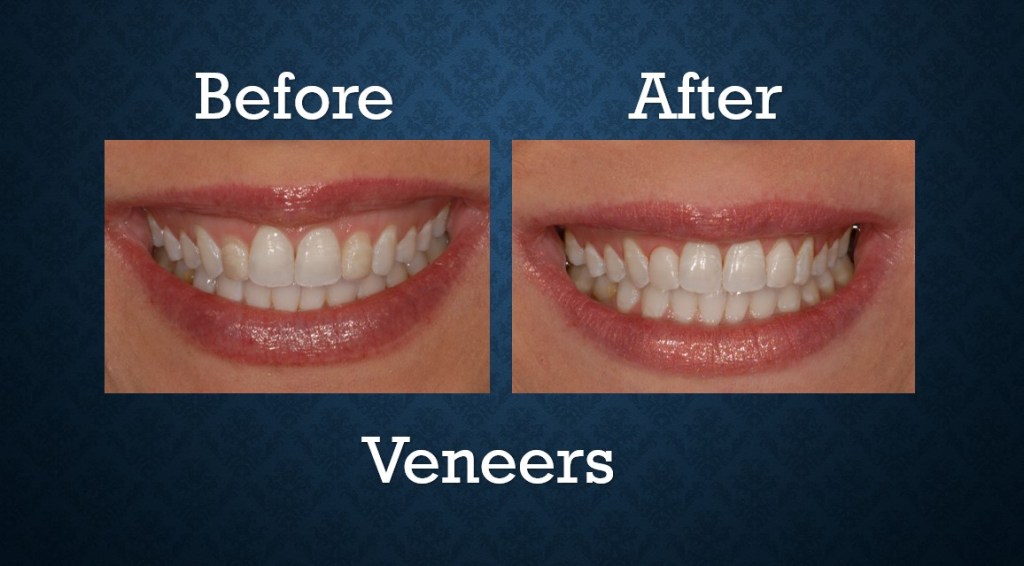 Before and after porcelain veneers treatment improving tooth shape, color, and overall smile appearance