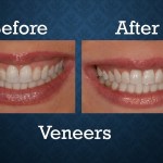 Before and after porcelain veneers treatment improving tooth shape, color, and overall smile appearance