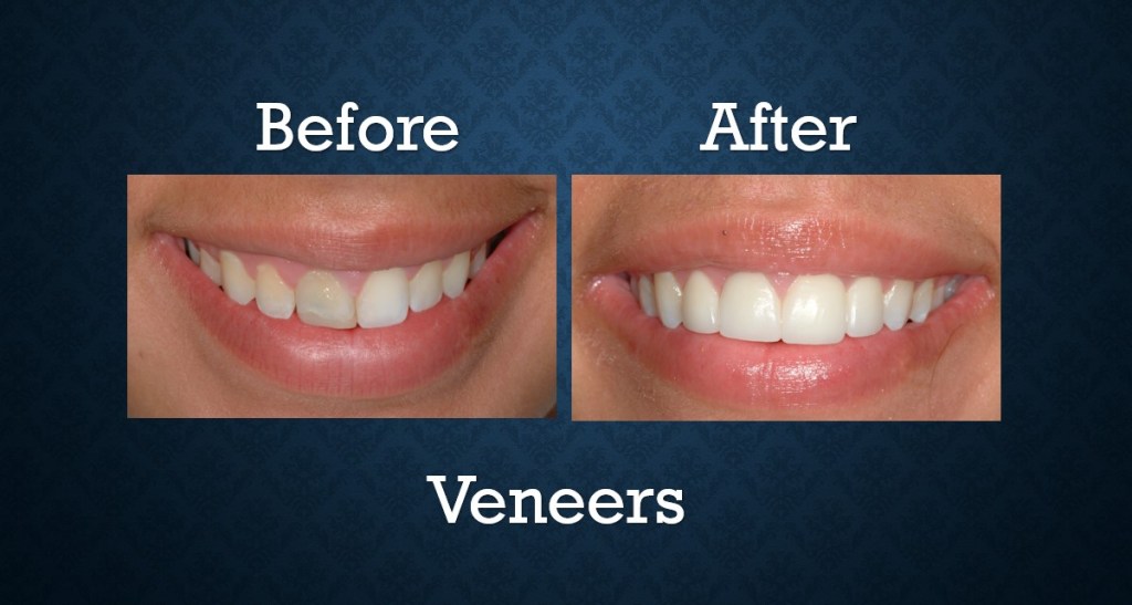 Before and after porcelain veneers treatment enhancing tooth color and smile aesthetics