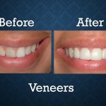 Before and after porcelain veneers treatment enhancing tooth color and smile aesthetics