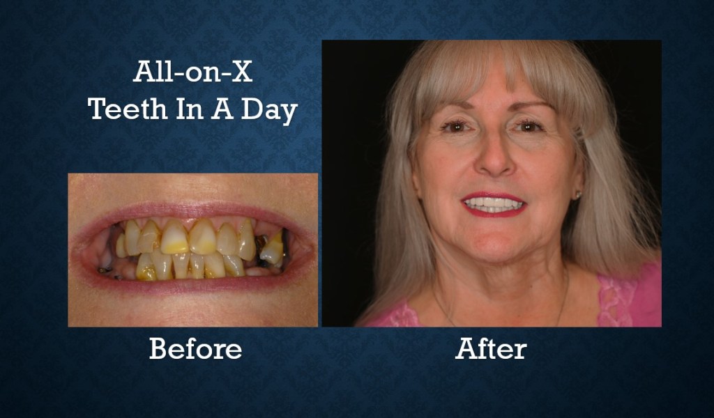 Before and after All-on-X dental implant treatment replacing missing teeth with a full-arch restoration