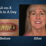 Before and after All-on-X dental implant treatment replacing missing teeth with a full-arch restoration