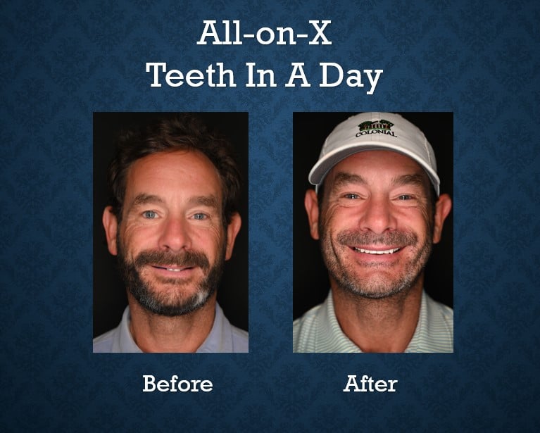 Before and after All-on-X Teeth-In-A-Day treatment restoring a full arch of missing teeth