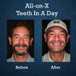Before and after All-on-X Teeth-In-A-Day treatment restoring a full arch of missing teeth