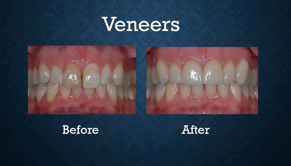 Before and after porcelain veneers treatment correcting tooth shape and smile symmetry