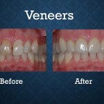 Before and after porcelain veneers treatment correcting tooth shape and smile symmetry