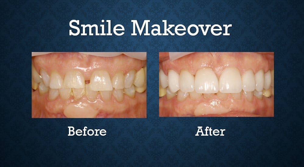 Before and after smile makeover treatment improving tooth alignment and overall smile appearance