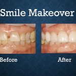 Before and after smile makeover treatment improving tooth alignment and overall smile appearance