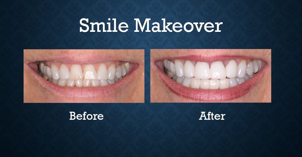 Before and after smile makeover treatment enhancing tooth color, shape, and smile aesthetics
