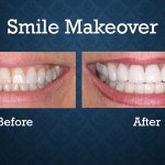 Before and after smile makeover treatment enhancing tooth color, shape, and smile aesthetics