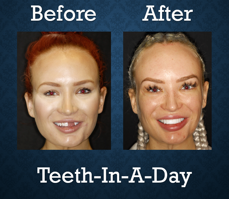 Before and after Teeth-In-A-Day treatment replacing missing teeth and restoring facial aesthetics
