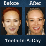 Before and after Teeth-In-A-Day treatment replacing missing teeth and restoring facial aesthetics