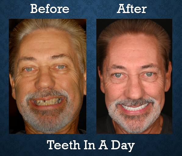 Before and after Teeth-In-A-Day treatment restoring a full smile with implant-supported teeth