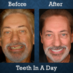 Before and after Teeth-In-A-Day treatment restoring a full smile with implant-supported teeth